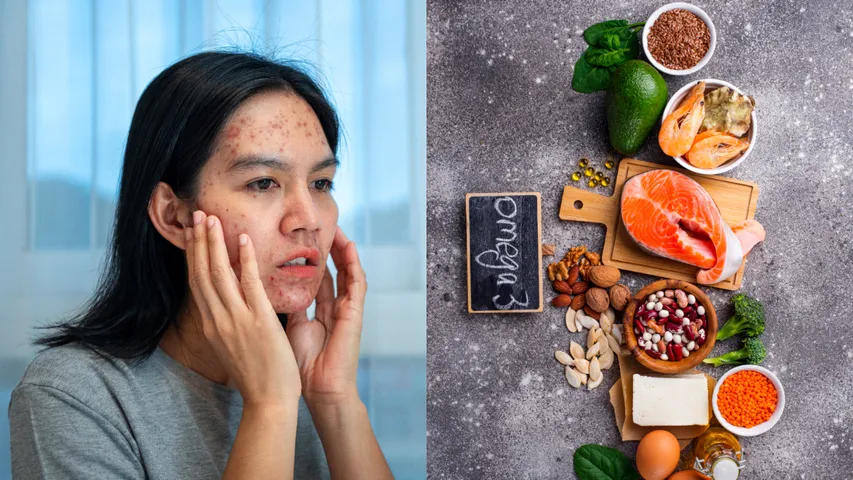Hormonal acne