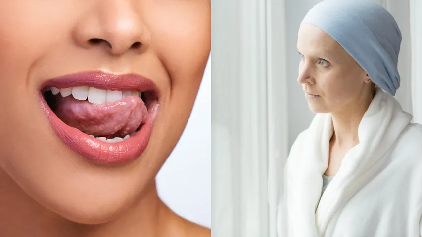 Tongue Vs Cancer