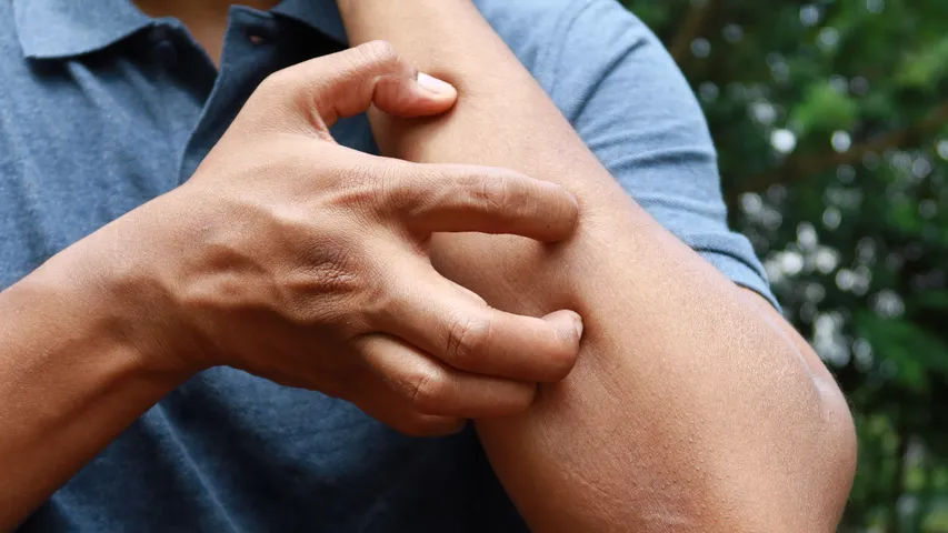 Itching