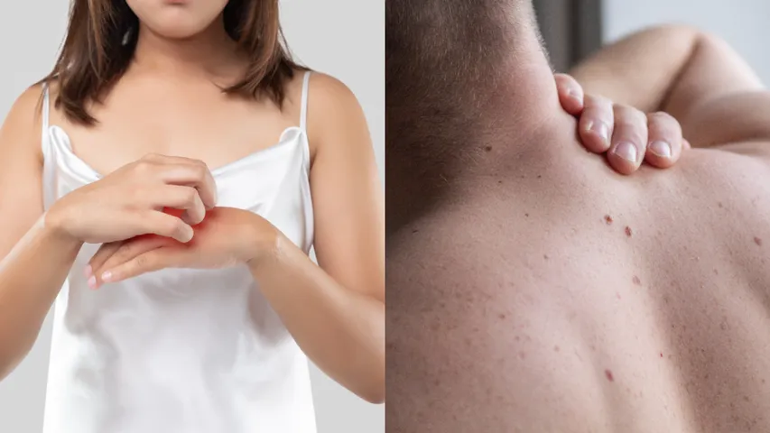 itching and Prickly Heat