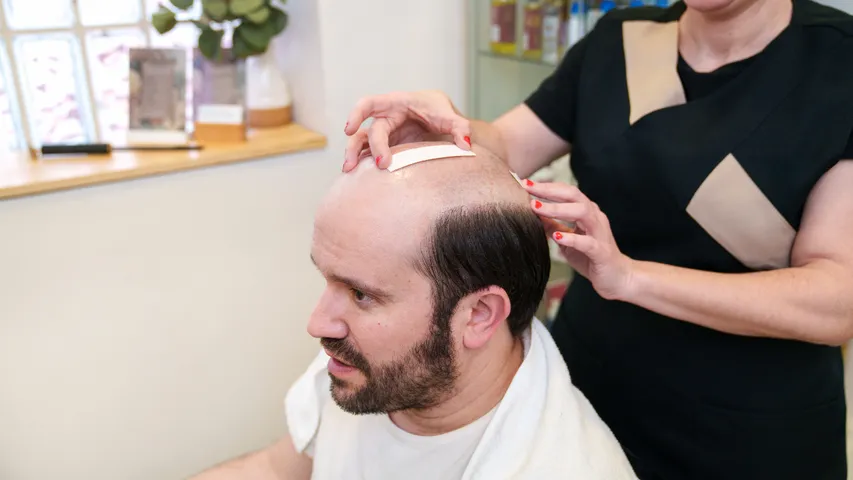 Hair Loss