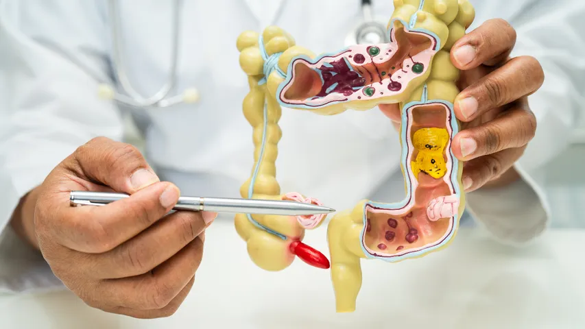 Colon Cancer