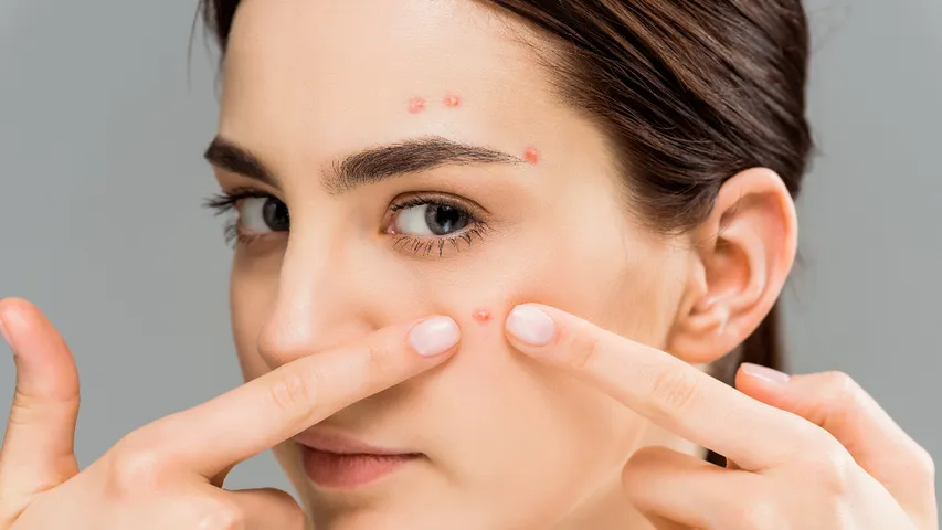 Pimples