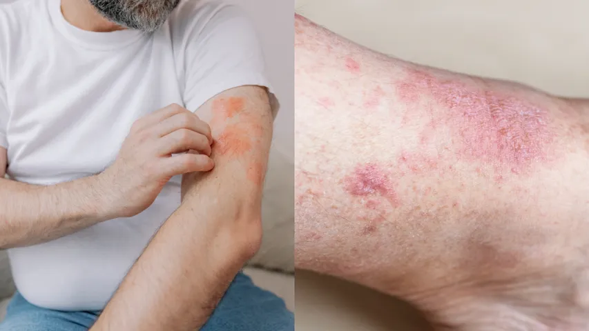 Skin Fungal