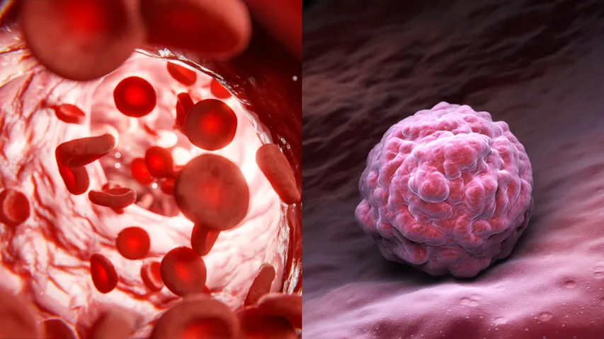 Blood Cancer
