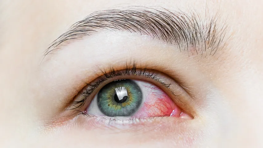 Pink Eye 