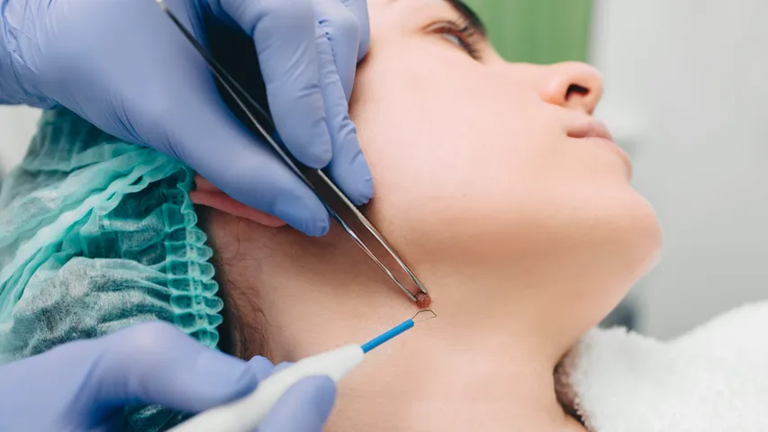 Neck Warts