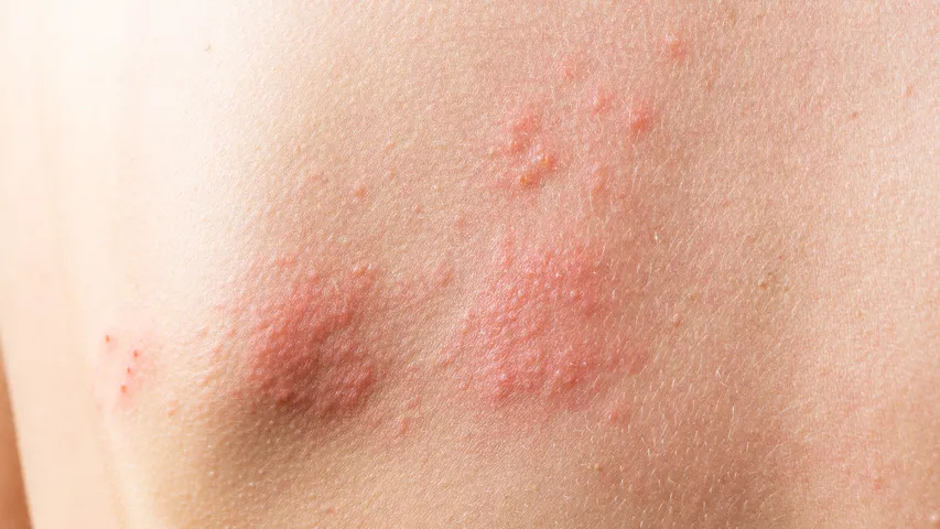 children rashes
