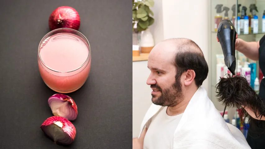 onion juice and bald