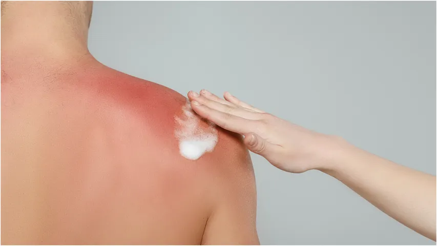 sunburn