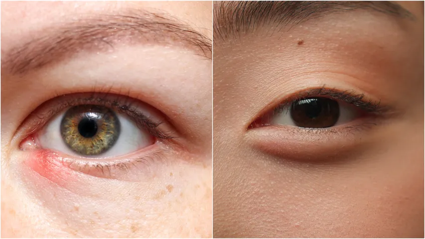 Swollen eyes