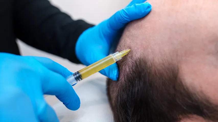 Hair Transplant