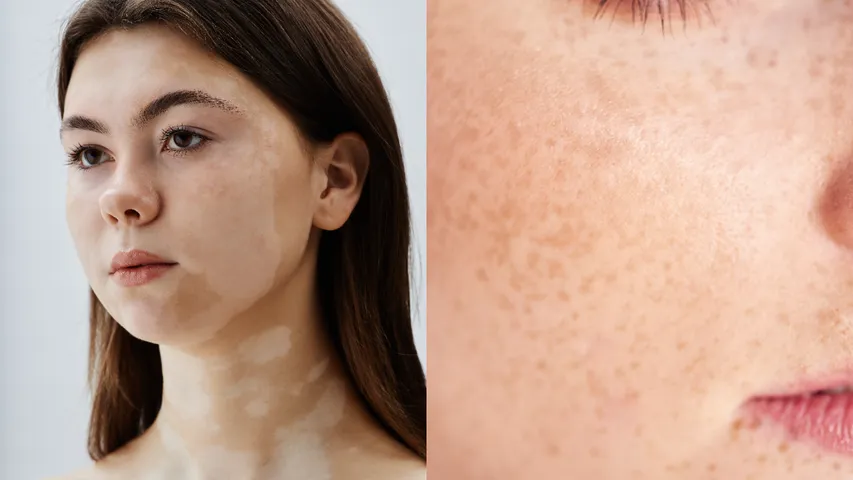 White Spots