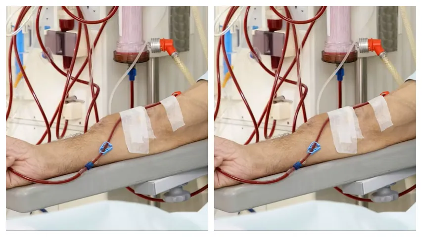 Dialysis