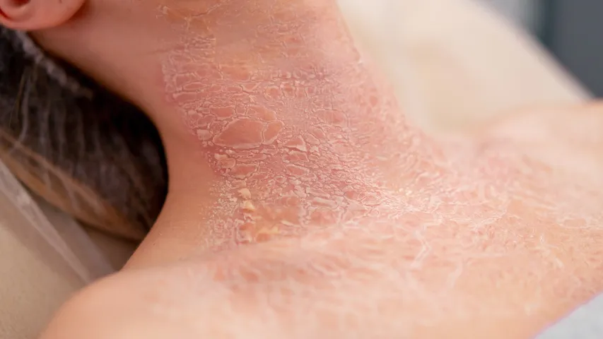 Skin Disease