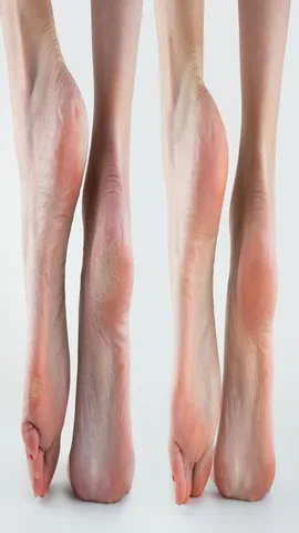 Fungal infection feet