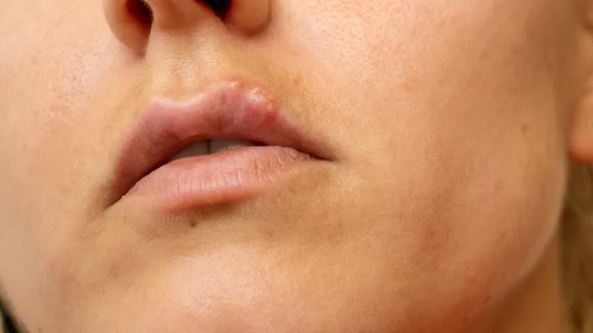 Girls moles