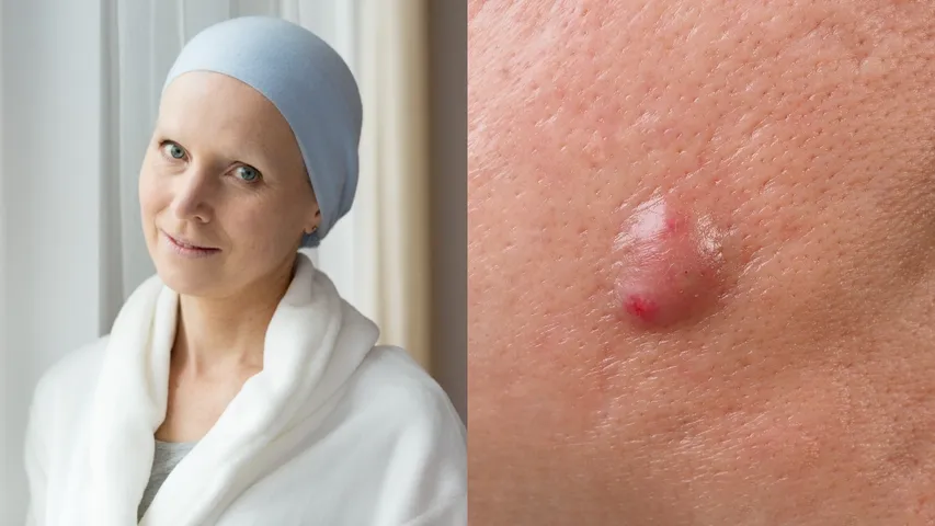 Skin Vs Bumps