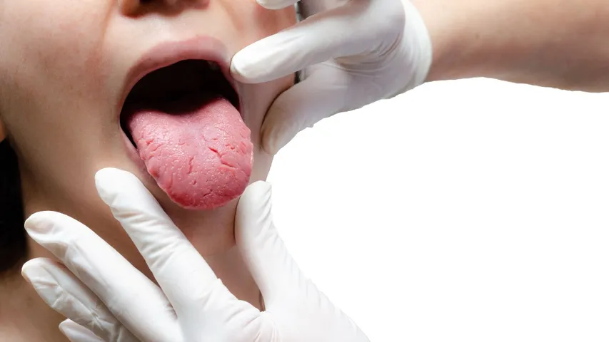 Symptoms on the tongue