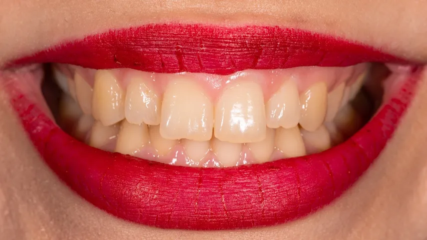 Yellow teeth
