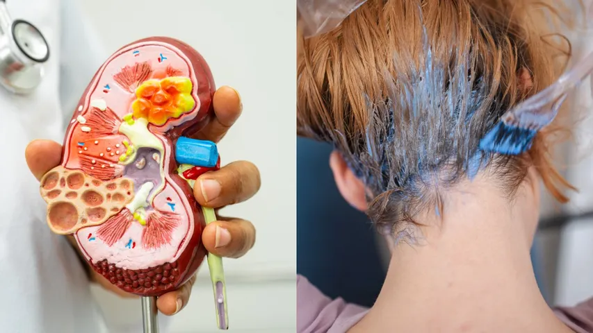 Kidney inflammation
