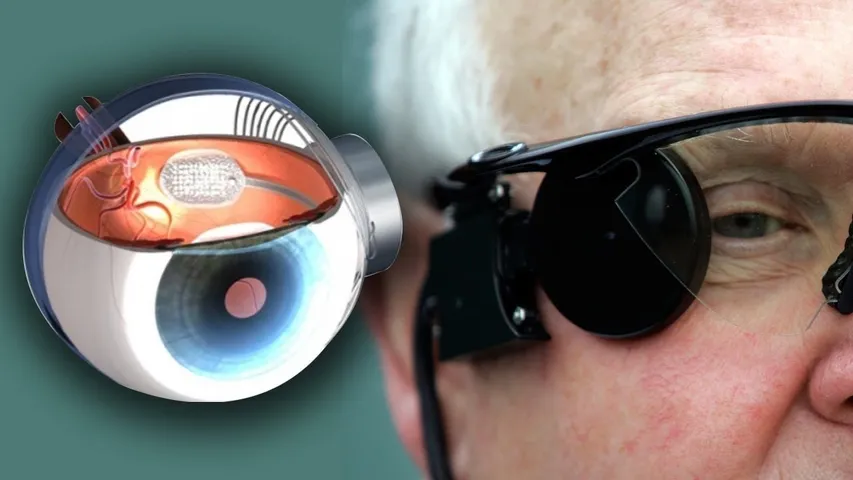 Retina Implant