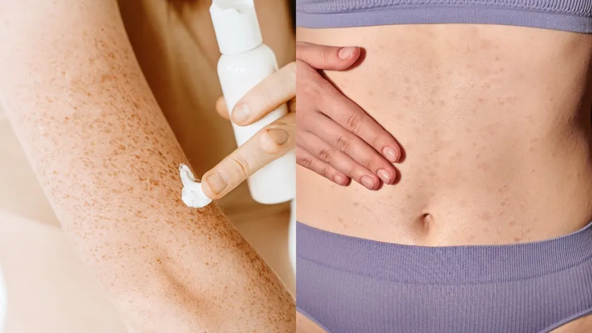 Dark spots on private parts