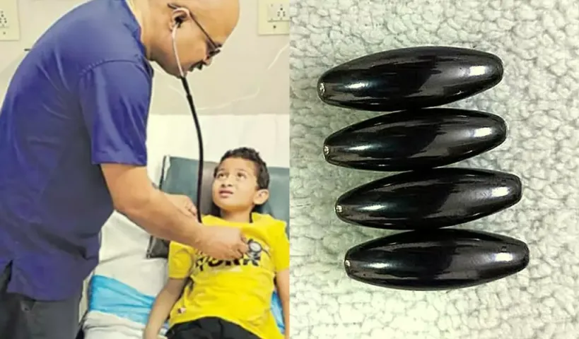 బాలుడి కడుపులో ఆయస్కాంతాలు.. అవాక్కైన వైద్యులు