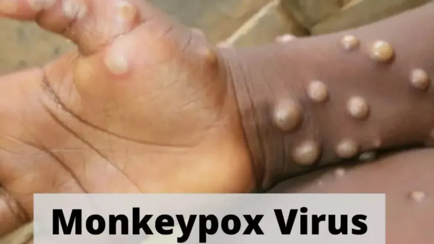 మంకీ పాక్స్ అలా కూడా సోకుతుందా!: ఆఫ్రికాలో డేంజర్ బెల్స్