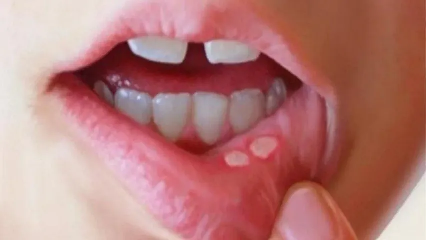 Mouth Ulcers: నోటి పూతతో ఇబ్బంది పడుతున్నారా..? తొందరగా తగ్గాలంటే ఇలా చేయండి