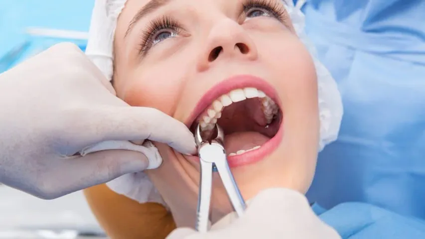 Wisdom Teeth Removed: తొందరపడి జ్ఞానదంతం తొలగించుకోవద్దు..వైద్యులు ఏమంటున్నారంటే