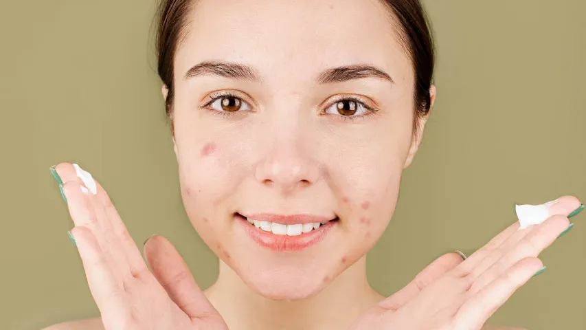 Pimple remove tips: మొటిమల నివారణకు ఇంటి చిట్కాలు.. ఇవి ట్రై చేసి చూడండి!