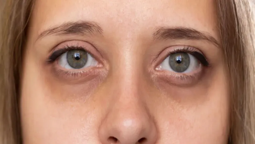 Dark Circles: ఈ సింపుల్‌ ట్రిక్స్‌తో డార్క్ సర్కిల్స్‌ను ఈజీగా తొలగించుకోవచ్చు!