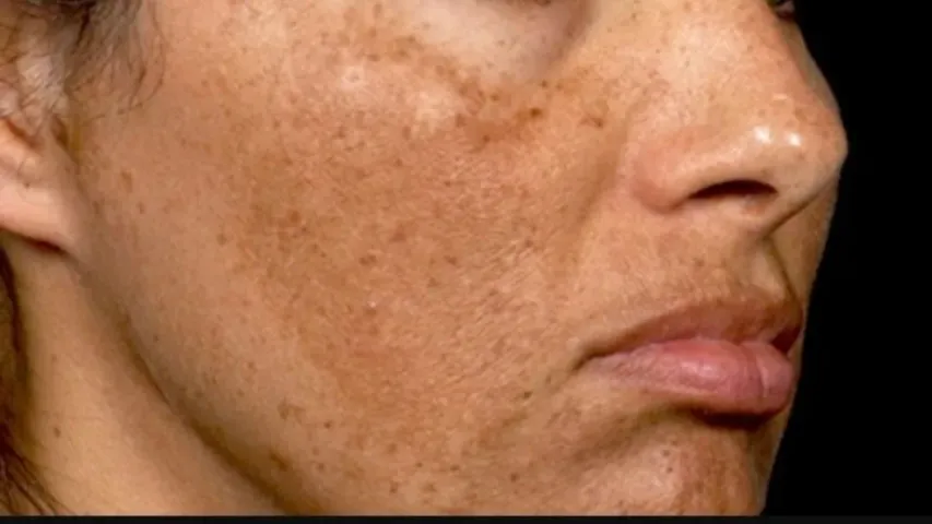 Beauty Tips: పిగ్మెంటేషన్‌కు చక్కటి ఔషధం కుంకుమపువ్వు.. చర్మ కాంతి రెట్టింపు