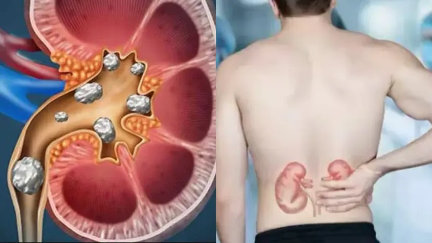Kidney Stones: కిడ్నీలో రాళ్లు ఉన్నాయా?..వీటిని అస్సలు తినకండి