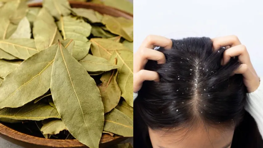 Bay leaves Tips: ఈ ఆకుతో.. డాన్డ్రప్ సమస్య దెబ్బకు మాయం