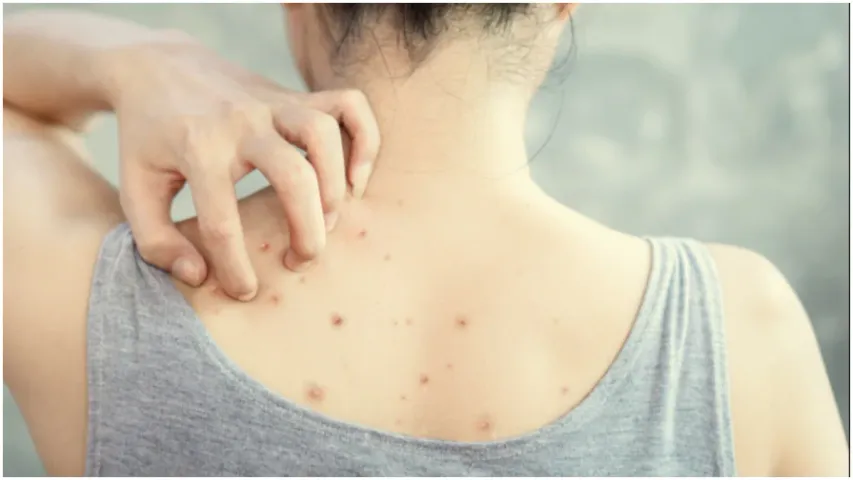 Back Acne: వీపు, బాడీ పై పింపుల్స్ వస్తున్నాయా.. అయితే ఇలా చేయండి..!