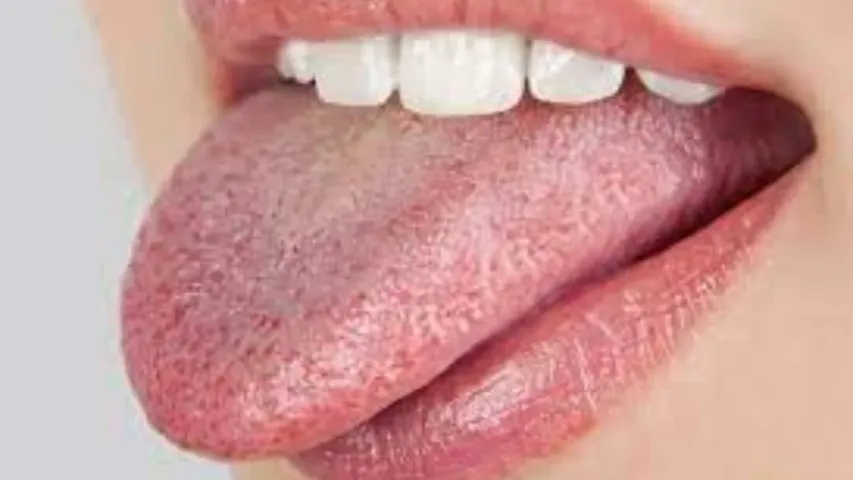 Tongue Tips: నాలుక మంటను వెంటనే తగ్గించే చిట్కాలు