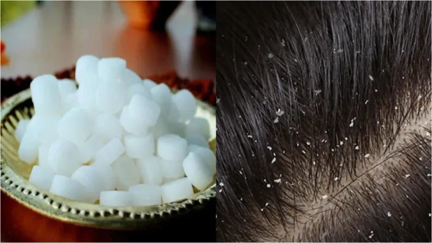 Dandruff : చుండ్రుతో బాధపడుతున్నారా? కర్పూరంతో ఇలా చేయండి..మేజిక్ చూడండి