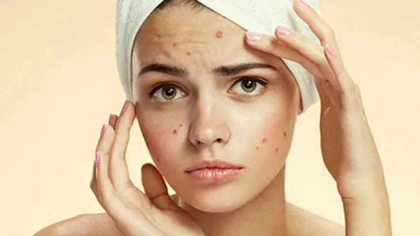 Pimples: ఈ అలవాట్లు ఉంటే.. మొటిమలు మరింత పెరుగుతాయి