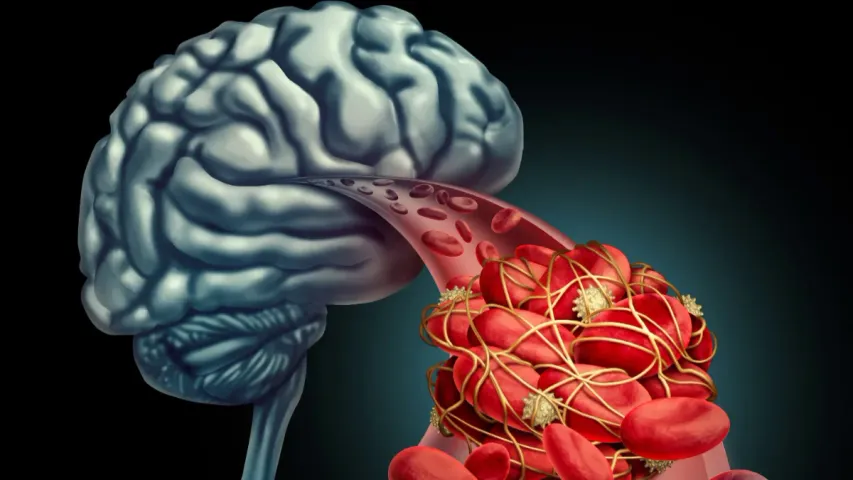 Brain Hemorrhage : మెదడులోని నరాలు పగిలితే ఏమవుతుంది?.. అలా జరగడానికి కారణాలేంటి?