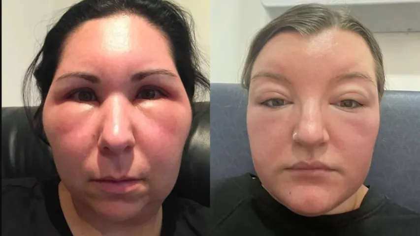 Swelling Face : ముఖం బెలూన్‌లా ఉబ్బిందా.. ఇలా చేయండి