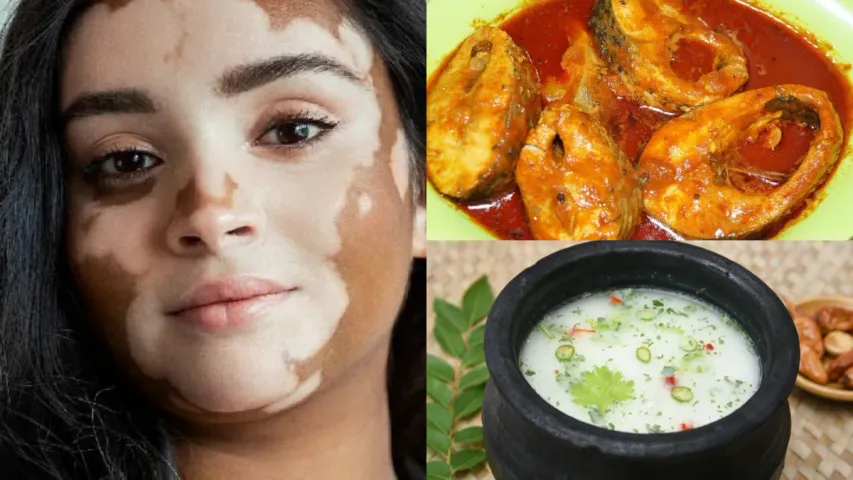Vitiligo Spots: చేపలు, మజ్జిగ కలిపి తింటే బొల్లి మచ్చలు వస్తాయా?