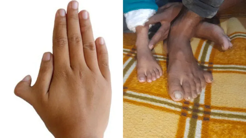 Six Fingers : కొందరి చేతికి ఆరు వేళ్లు ఎందుకు ఉంటాయి?.. కారణం ఇదేనా?