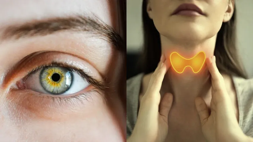 Health Tips: కళ్లకు కూడా థైరాయిడ్‌ వస్తుందా?.. లక్షణాలు ఎలా ఉంటాయి?