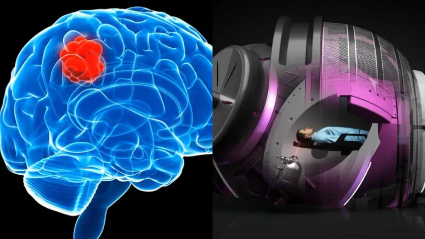 Brain Tumor Treatment: అరగంటలో బ్రెయిన్‌ ట్యూమర్‌కి చికిత్స.. ఖర్చు ఎంతంటే?