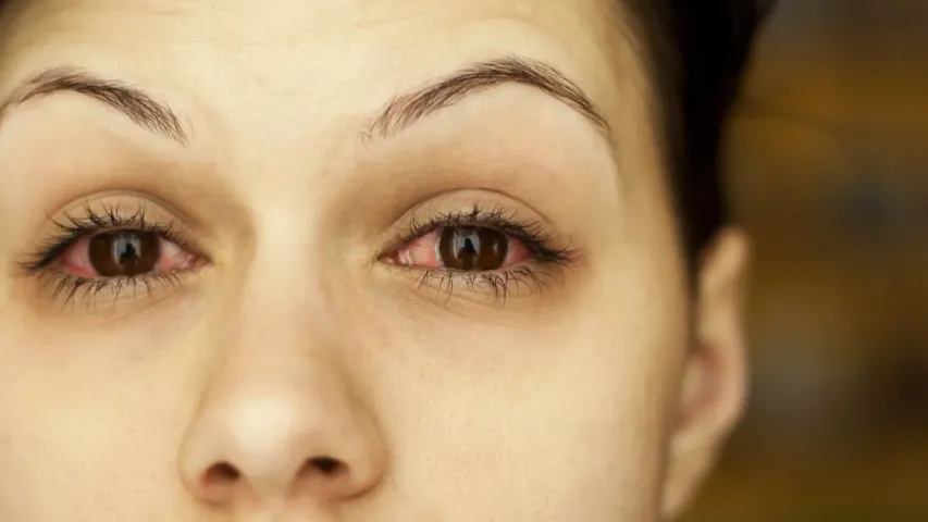Eye inflammation: కళ్లలో మంట, దురదగా ఉందా?.. అస్సలు ఆలస్యం చేయొద్దు
