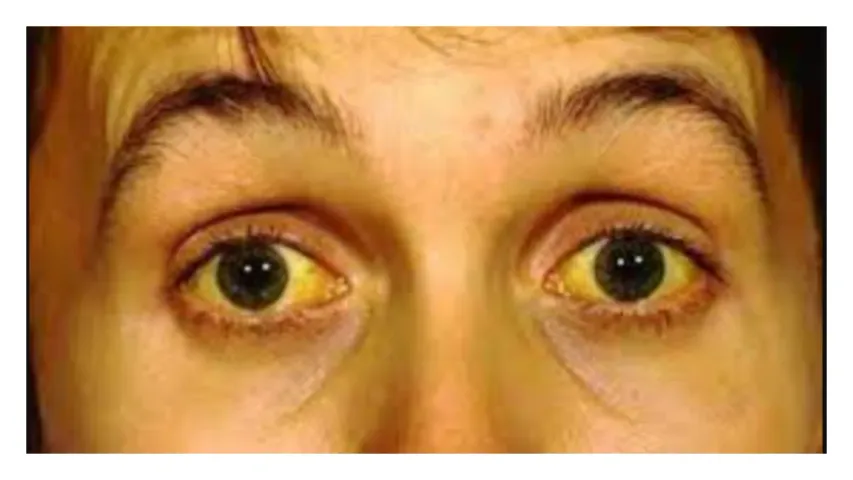Jaundice: కామెర్లు వచ్చినప్పుడు ముఖం, కళ్ళు పసుపు రంగులోకి ఎందుకు మారుతాయి?