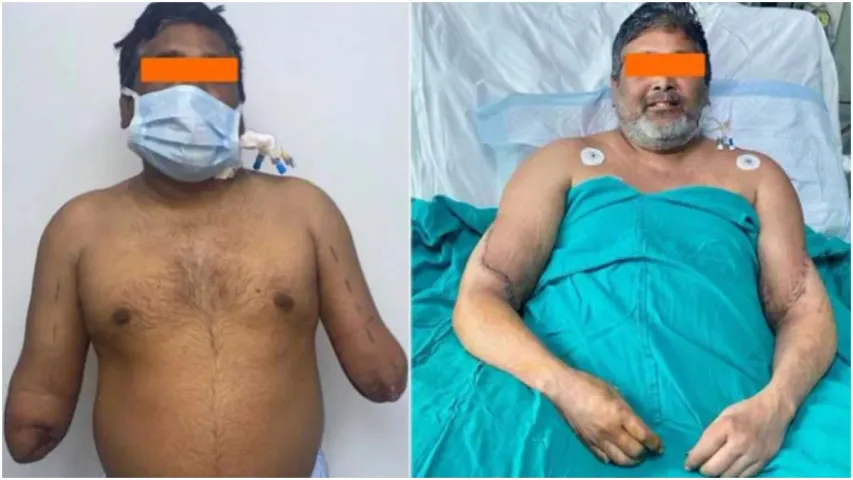 Delhi: చేతుల ట్రాన్స్‌ప్లాంటేషన్..ఢిల్లీ వైద్యుల మిరాకిల్