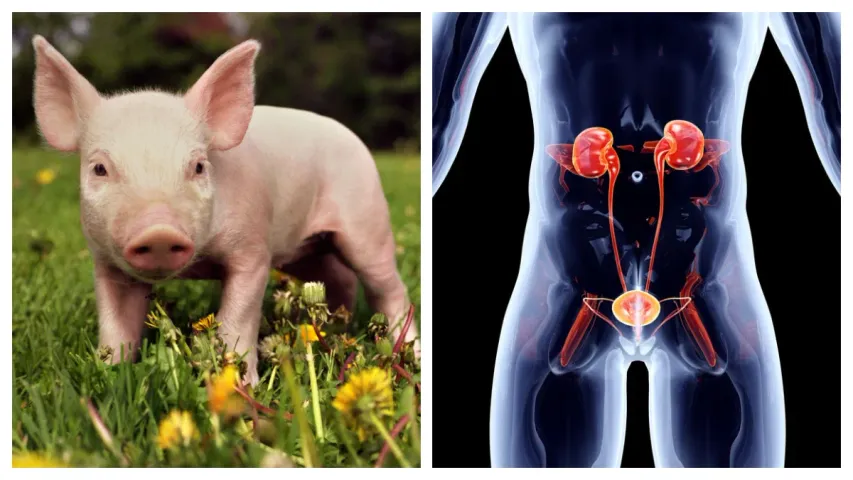 Kidney: పంది కిడ్నీనీ మనిషికి అమర్చిన అమెరికన్ వైద్యులు!
